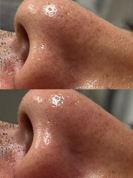 アットウィル 志木店(at will)/メンズ毛穴洗浄BeforeAfter