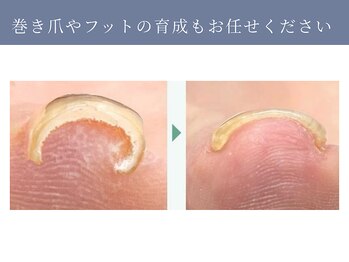 イデアル(ide’al)/巻き爪もジェルで改善
