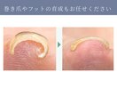 巻き爪もジェルで改善