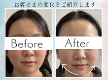 さくら鍼灸院 整骨院/美容鍼1