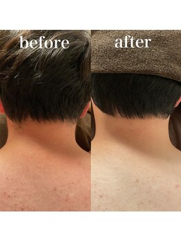 ミノア 大野城店(MINOA)/メンズうなじ脱毛ビフォーアフタ