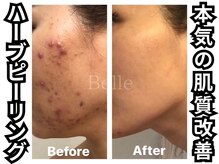 ベル 南船場店(Belle)の雰囲気(ハーブピーリングでニキビケア!圧倒的症例実績◎毛穴/シミケアも)