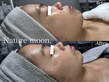 ナチュールムーン(Nature moon.)/ハーブピーリング