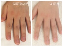 キレイテ 福岡天神店/40代/4回目【天神ハンドケア】