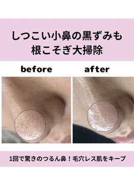 ユズドット(yuzu.)の写真/【毛穴洗浄の新常識】押し出さない！水素でごっそり落とす全顔 毛穴洗浄★痛みなし驚きのつるん鼻
