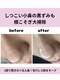 ユズドット(yuzu.)の写真/【毛穴洗浄の新常識】押し出さない！水素でごっそり落とす全顔 毛穴洗浄★痛みなし驚きのつるん鼻
