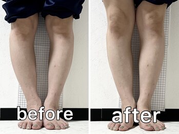 サンク(Cinq)/【骨盤矯正+O脚矯正】歪み改善