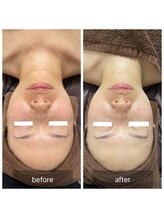 メロウゴールド(Mellow Gold)/剥離なし幹細胞ハーブピーリング