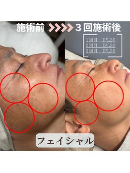 セレステ(Sereste)/光フェイシャルB＆A　３回施術後