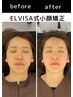 【☆面長、コケ感を徹底改善☆】小顔矯正×EMSリンパトリートメント