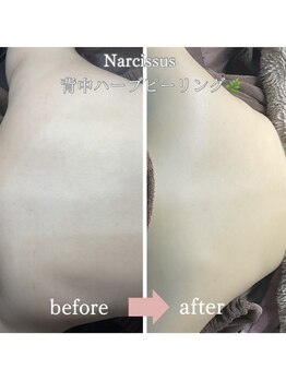 ナルシス(Narcissus)/背中ピーリンクbefore→after