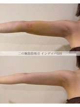 ブラン(blanc)/術後インディバ5回