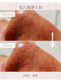 ル シャ/メンズ脱毛/毛穴洗浄/ヘッドスパ