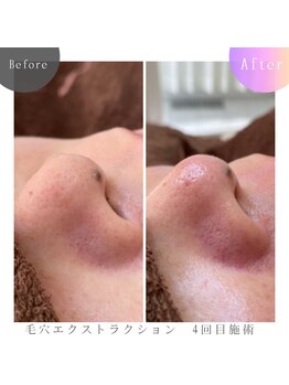 ラブ ザ テラス(Luv the TERRACE)/毛穴洗浄:黒ずみ・いちご鼻