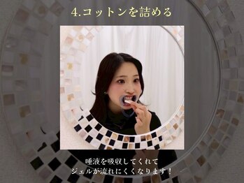 ホワイトニングサロン ホワイト 天童店(WHITE)/4.コットンを詰める