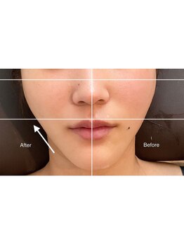 アリュール(Allure)/引き上げサーマルフラクショナル