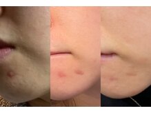 ルーナジェーナ(Luna llena)/肌質改善／肌ファスティング