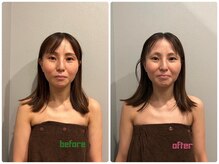 イチ(ichi)/小顔調整　一回の変化
