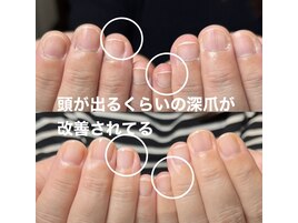 自爪育成/深爪育成/ジェルネイル