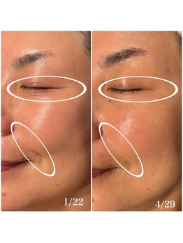 楚々(SOSO)/施術4回目