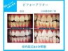 (セルフホワイトニングが初めての方に)無料カウンセリング