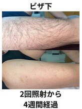 エスプラス エヌプラス(S+/N+)/ビフォアフ