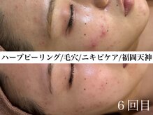 ホワイトアクア 福岡天神店(WHITE AQUA)/ハーブピーリングビフォー