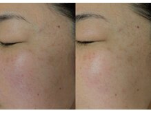 マインドール/赤み軽減、凹凸なめらかに。