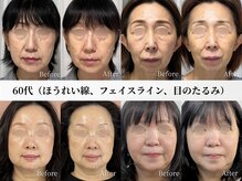 アストリエ グレース 相模大野(Astorie Grace)/リフトアップ｜Before→After