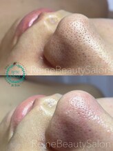 レーヌ(Reine)/毛穴エクストラクションハーブ