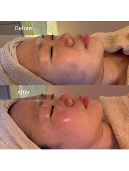 アイビー 二子玉川店(IB)/すっきりリフトアップ☆