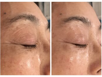 リュウ鍼灸院 サロン ド リュウ(Salon de Ryu)/シワ改善例