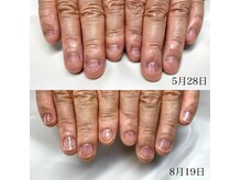 人気No.1の深爪矯正！かみ癖むしり癖のあるかたもここまで成長！