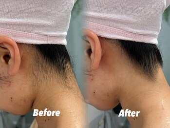 クイーン 渋谷店(QUEEN)/脱毛当日もOK！