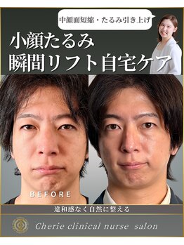 シェリー(Cherie)/インセルダム【小顔たるみケア】