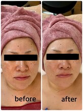 シュガー(Sugar...iyr)/【REVI】陶肌トリートメント初回