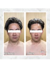 フローフシ∞/【小顔】30代男性症例写真