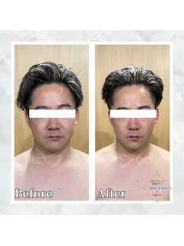フローフシ∞/【小顔】30代男性症例写真