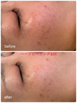 ミレボ(Me.rebo)/ハーブピーリング1回のB→A