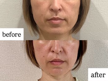 マカオン(machaon)/【小顔リフト】小顔マッサージ