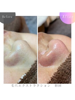 ラブ ザ テラス(Luv the TERRACE)/毛穴洗浄:黒ずみ&角栓ケア