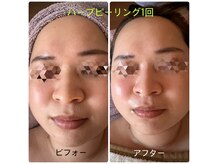 ミヤビ(MIYABI)の雰囲気(ハーブピーリングコース剥離なし◎植物由来の力で再生能力UP!)