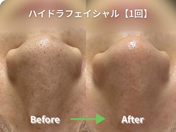 リソルバイスリール(Re:sol by sourire)/毛穴・ハーブピーリング専門店