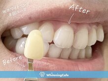 ホワイトニングカフェ 立川店(WhiteningCafe)/◎歯のホワイトニング施術写真◎