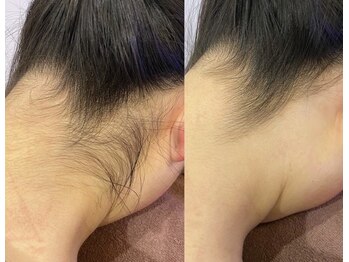 エム(M)/【うなじ】ダブル脱毛