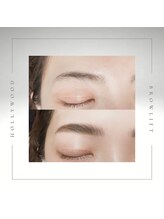 Hollywood Brow Lift