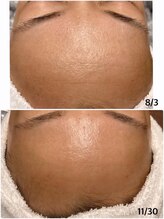 楚々(SOSO)/気になるおでこのお手入れにも♪