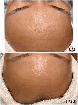 楚々(SOSO)/気になるおでこのお手入れにも♪