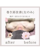 ビューティフィール アンド アリサナ(Beauty Feel&Arisana)/アリサナ症例写真　巻き肩調整