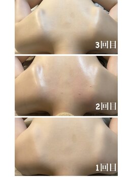 十美/リンパマッサージbefore after